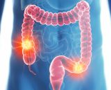 COLON_CANCER