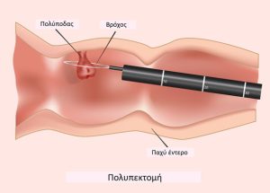 Polypectomy-GR
