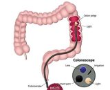 colonoscopy-treatment-singapore