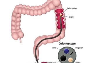 colonoscopy-treatment-singapore