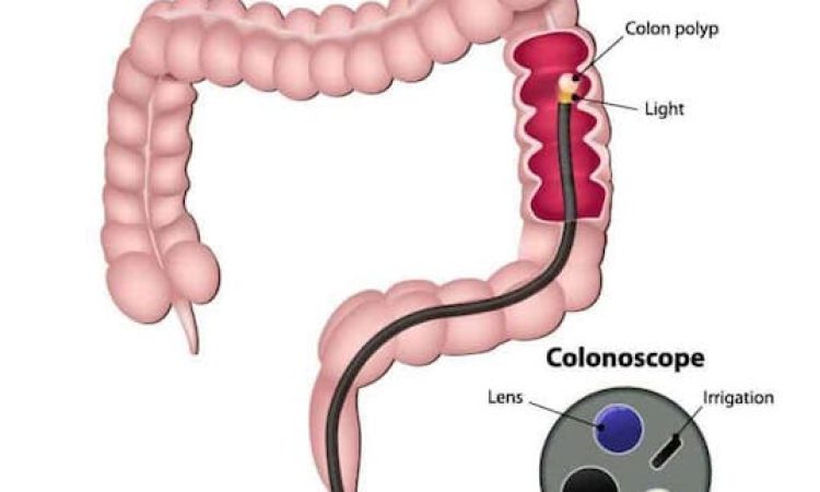 colonoscopy-treatment-singapore
